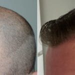 The Fascinating Journey of Hair Transplantation: From Techniques to Aftercare - Everything You Need to Know!