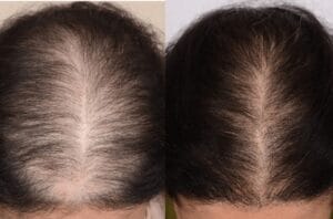 Пересадка волос в Турции: личный опыт, цены, страны