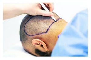 Пересадка волос в Турции