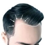 Пересадка волос в Турции: личный опыт, цены, страны