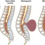 Лечение Спина бифида (Расщепление позвоночника) в Турции: Комплексный подход и лучшие врачи