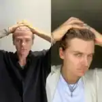 Пересадка волос: честный разговор о том, что вас волнует