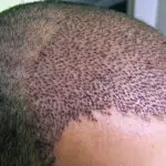 пересадка волос