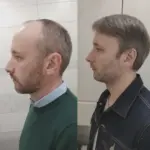 пересадка волос в Турции