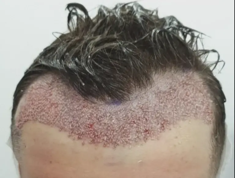 метод DHI пересадка волос