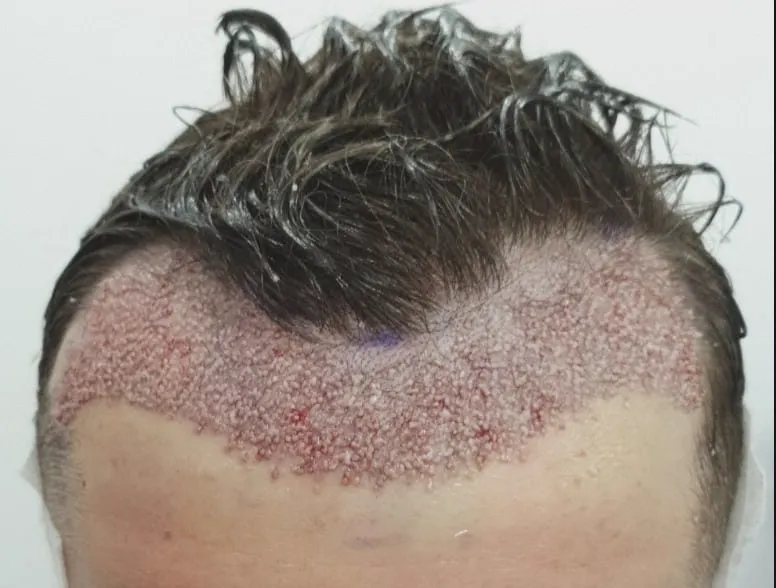 метод DHI пересадка волос