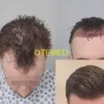 имплантация волос без бритья