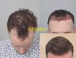 имплантация волос без бритья