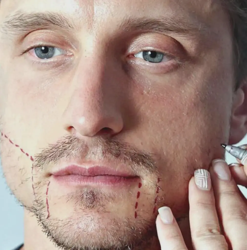 пересадка бороды