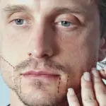 пересадка бороды