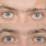 пересадка бровей