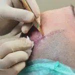 пересадка волос FUE