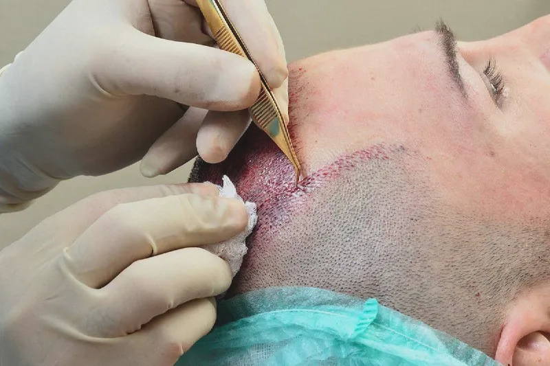 пересадка волос FUE