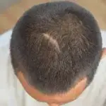 пересадка волос рубцы