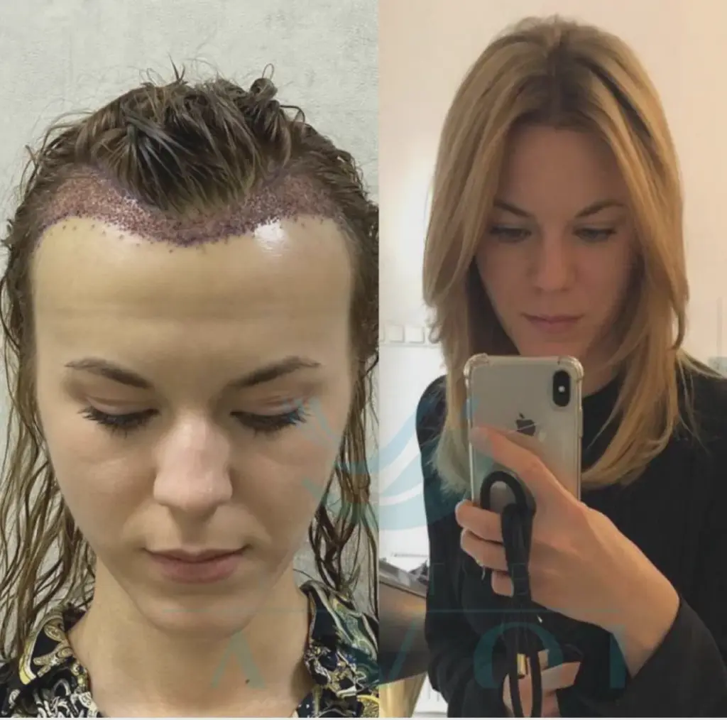 трансплантация волос у женщин,