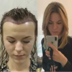 трансплантация волос у женщин,