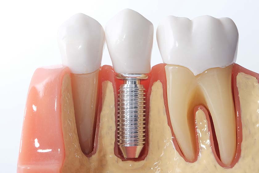 лечение зубов в турции