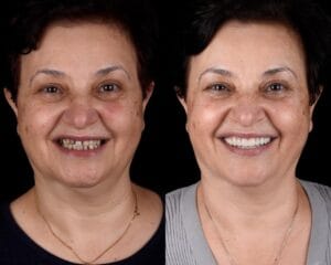 лечение зубов в турции