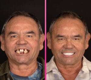 лечение зубов в турции