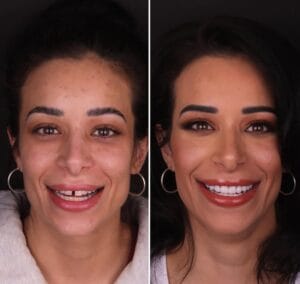 лечение зубов в турции