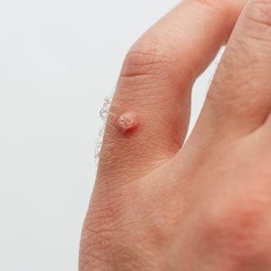 Удаление папиллом — цены, методы, врачи