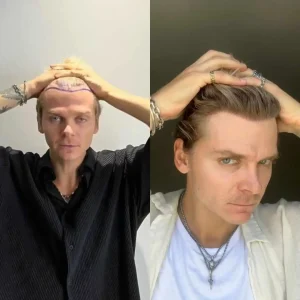 Пересадка волос: честный разговор о том, что вас волнует