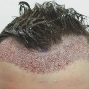 метод DHI пересадка волос