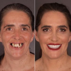 Цены на лечение зубов в Турции: сколько стоит стоматология