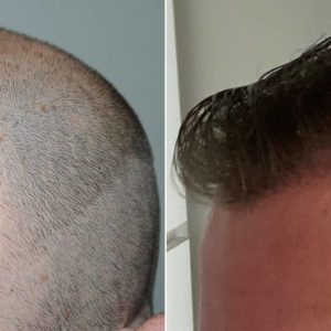 The Fascinating Journey of Hair Transplantation: From Techniques to Aftercare – Everything You Need to Know!