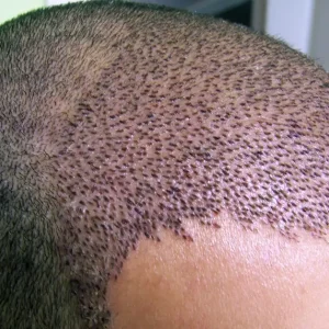 Пересадка волос: честный разговор о возвращении уверенности