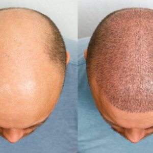 The head of a balding man before and after hair transplant surgery. A man losing his hair has become shaggy. An advertising poster for a hair transplant clinic. Treatment of baldness