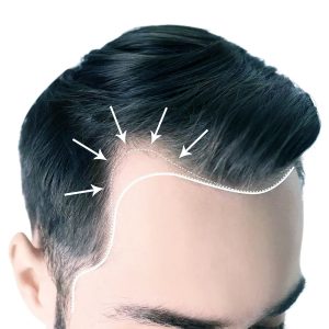 Пересадка волос в Турции: личный опыт, цены, страны