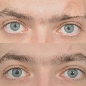 Пересадка бровей: естественная форма и тонкая работа